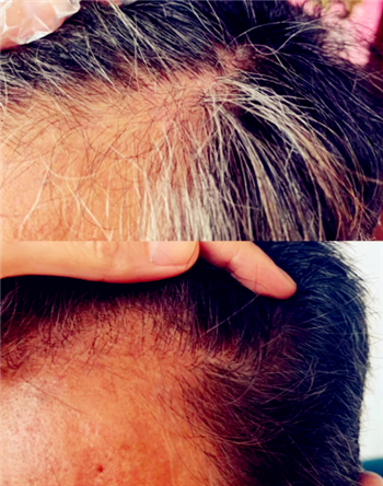 魔术丝能治秃顶吗2