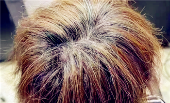 魔术丝能治疗脱发吗3