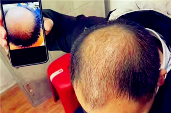 魔术丝能治秃顶吗3